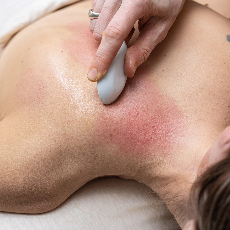 A patient having Gua Sha on her upper back --having the skin gently scraped with a Gua Sha spoon.