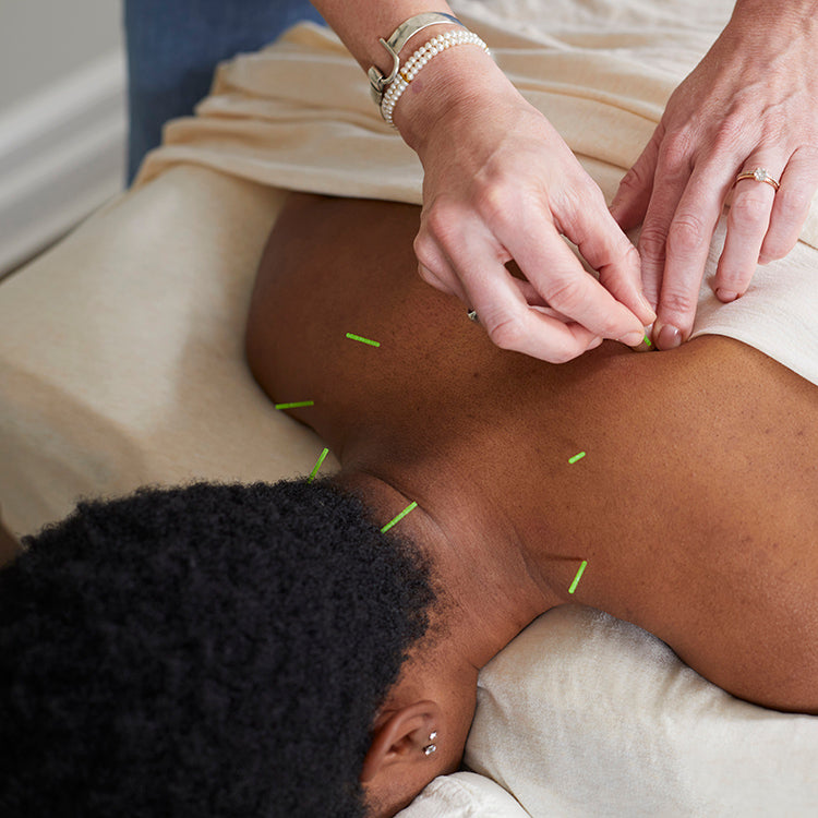 A patient receiving acupuncture treatment on her neck and back in a treatment room.